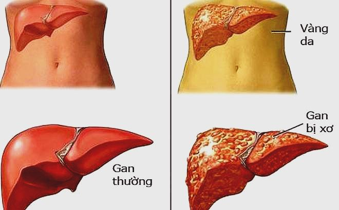 stress kéo dài gây gan khí uất