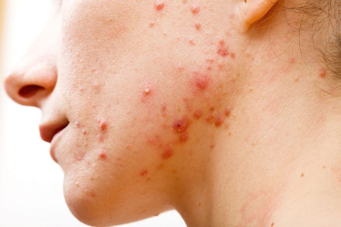 MỤN NỘI TIẾT Ở PHỤ NỮ TRƯỞNG THÀNH