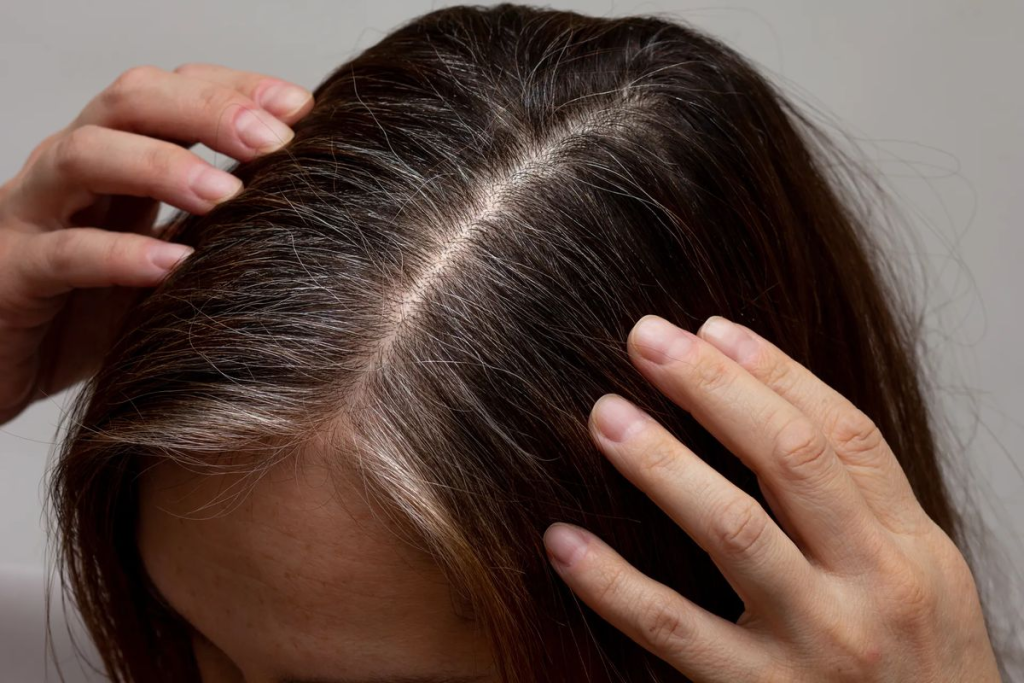 TÓC BẠC Ở PHỤ NỮ GẦY CÓ LIÊN QUAN NỘI TIẾT?