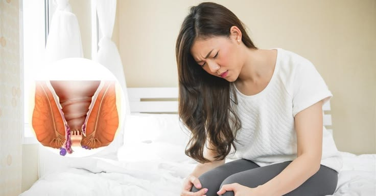 CHỮA BỆNH TRĨ KHÔNG CẦN PHẪU THUẬT