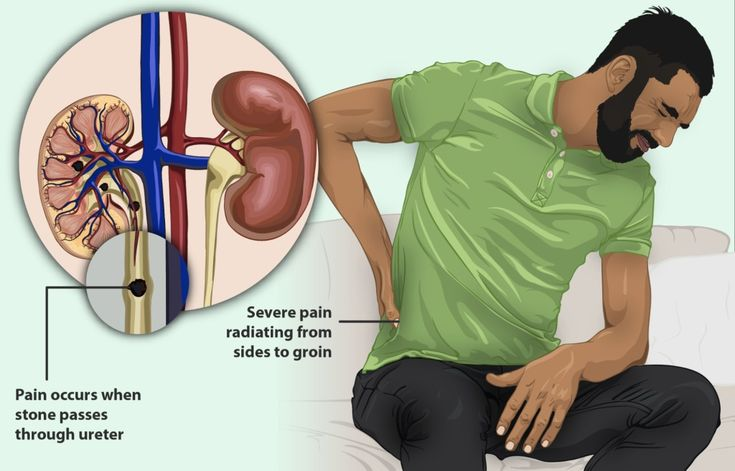 ĂN GÌ ĐỂ PHÒNG NGỪA SỎI THẬN HIỆU QUẢ