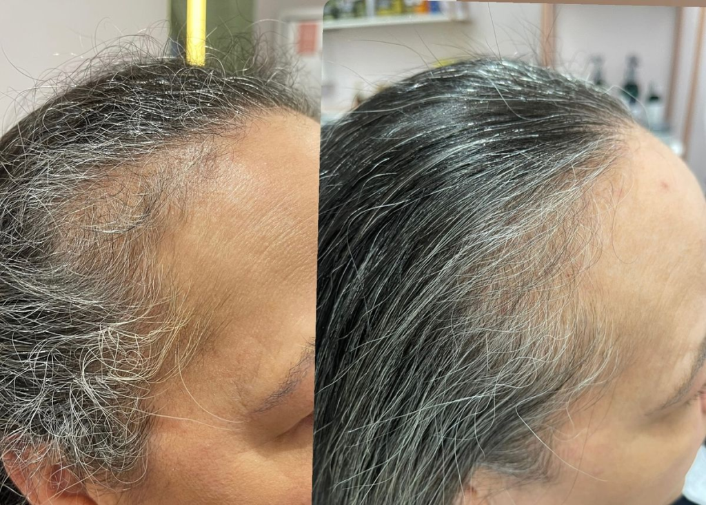 BẠC TÓC SAU ĐIỀU TRỊ UNG THƯ